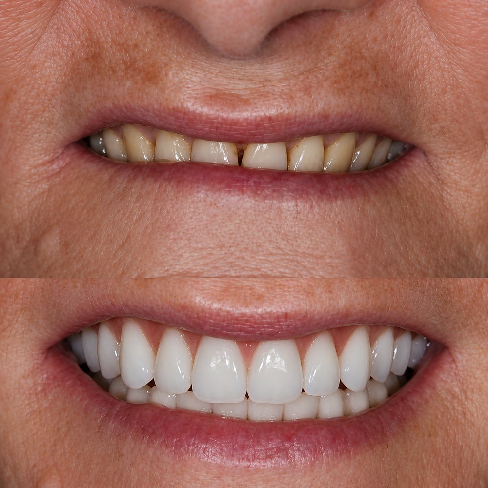 Comparativo do sorriso de um paciente antes e depois do tratamento com dentes fixos